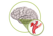 EPA te ayuda: ¿Qué es un accidente cerebro vascular y cuáles son sus implicancias?