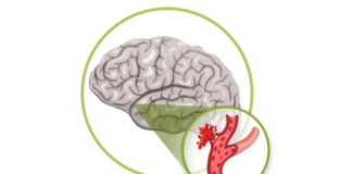 EPA te ayuda: ¿Qué es un accidente cerebro vascular y cuáles son sus implicancias?